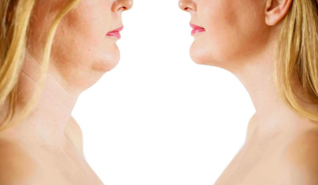 Double Chin treatment Wisbech before and after results