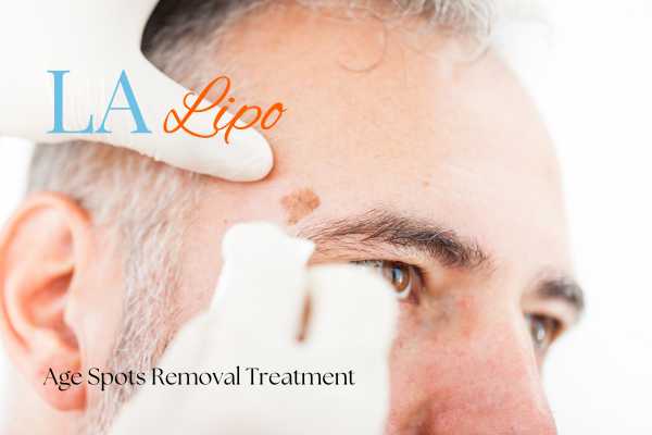 What Are the Most Effective Treatments for Age Spots Wisbech?