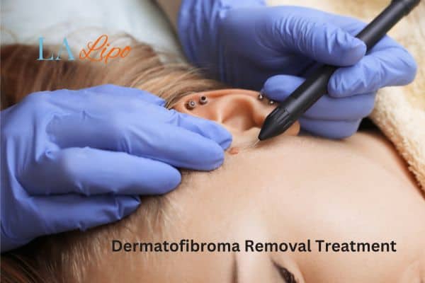 Dermatofibroma Removal Treatment Wisbech