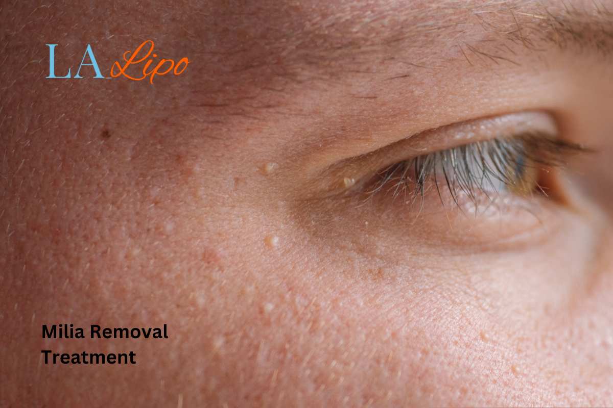 Cryopen Milia Removal: Is It the Easiest and Safest Option Wisbech?