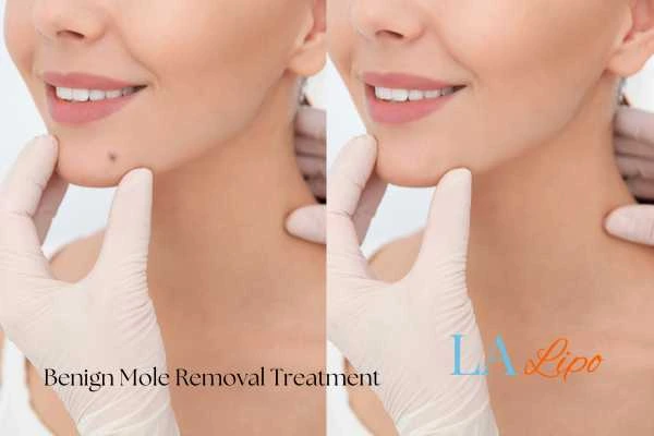 woman's before and after mole removal Wisbech results