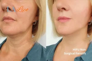hi-fu for wrinkles Wisbech before and after results