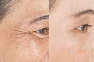 Before and after results of woman - HI-fu wrinkles reduction treatment Wisbech