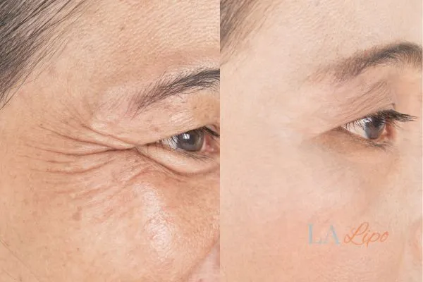 Before and after results of woman - HI-fu wrinkles reduction treatment Wisbech
