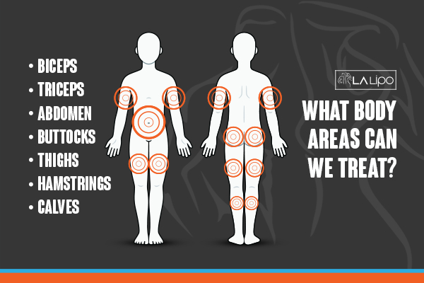 Graphic to show areas you can have LA-EMS Body Sculpting Wisbech treatment.