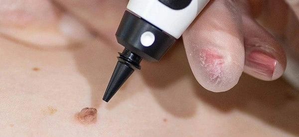 skin tag removal using cryopen Wisbech