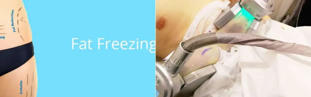Fat freezing Wisbech on multiple areas of the body