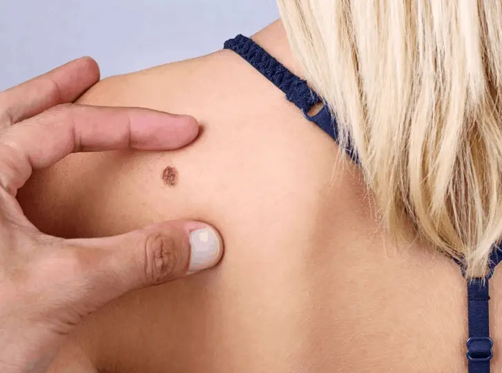 woman having mole removal Wisbech consultation before treatment.
