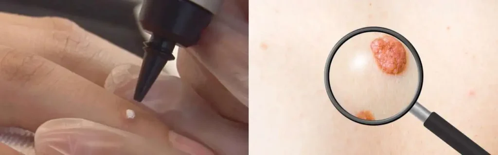 Cryopen for mole removal Wisbech - speak to our team today!