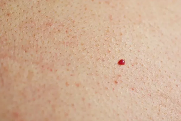 close up of a cherry angioma Wisbech