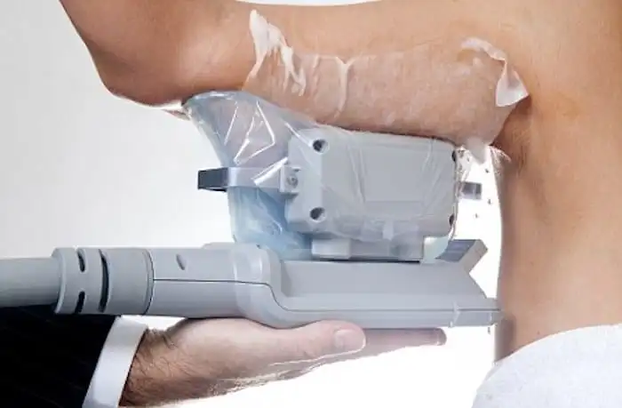 Picture of fat freezing Wisbech on the upper arms.