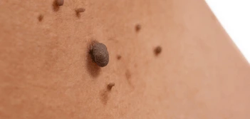 image of a skin tag Wisbech