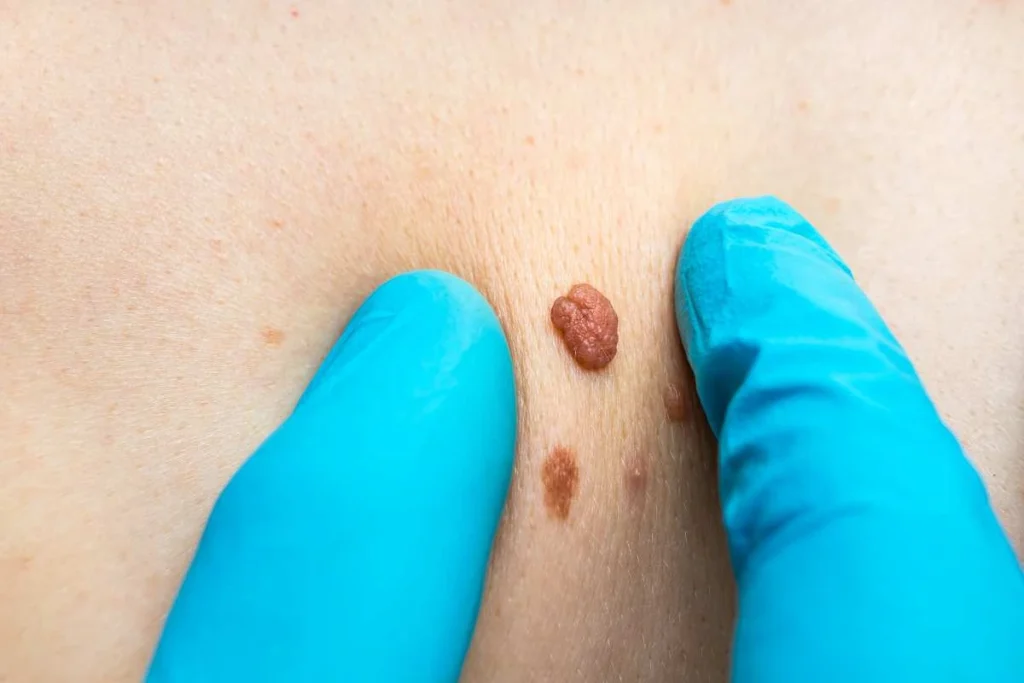 Consultant examining a skin tag Wisbech