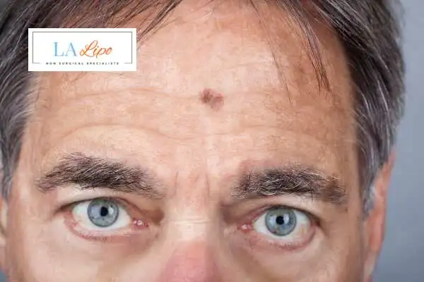 Solar Lentigo Removal Wisbech image of man with mark on his forehead