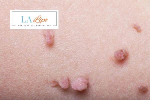 Does cryopen skin tag removal Wisbech hurt? Find out now call our team today!