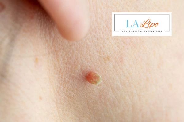 Book skin tag removal Wisbech today speak to our team now!