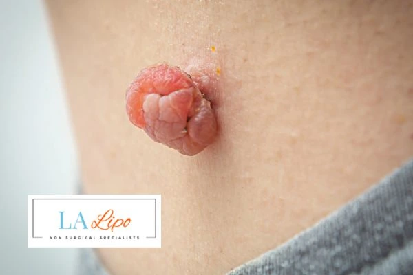 Interested in skin tag removal Wisbech? Concerned about the pain? Find out more today!