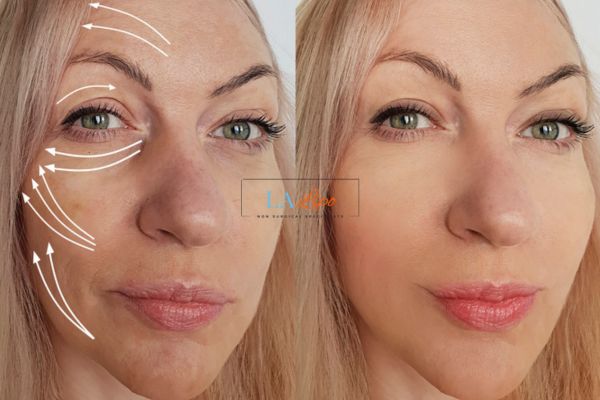 Morpheus 8 results Wisbech face lift.