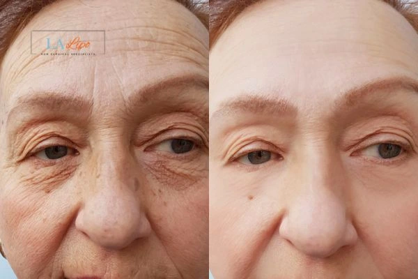 The powerful benefits of Morpheus8 Treatment Wisbech - Call Our team today!