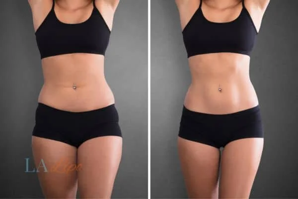before and after results of non-surgical treatment to help a woman's body image and mental health Wisbech
