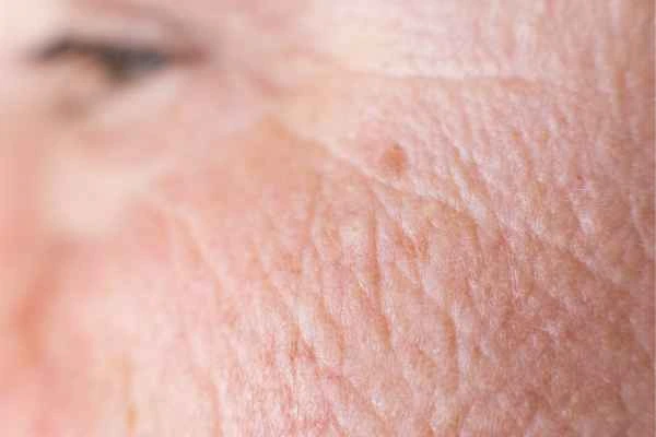 close up picture of a woman's face showing an age spot Wisbech