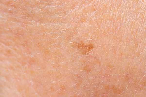 close up picture of age spots Wisbech