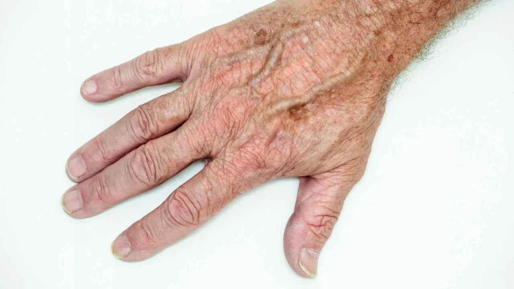 Male hand showing age spot Wisbech