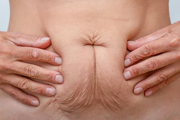 Should I Combine Diastasis Recti Treatment with Body Contouring for Better Results Wisbech?