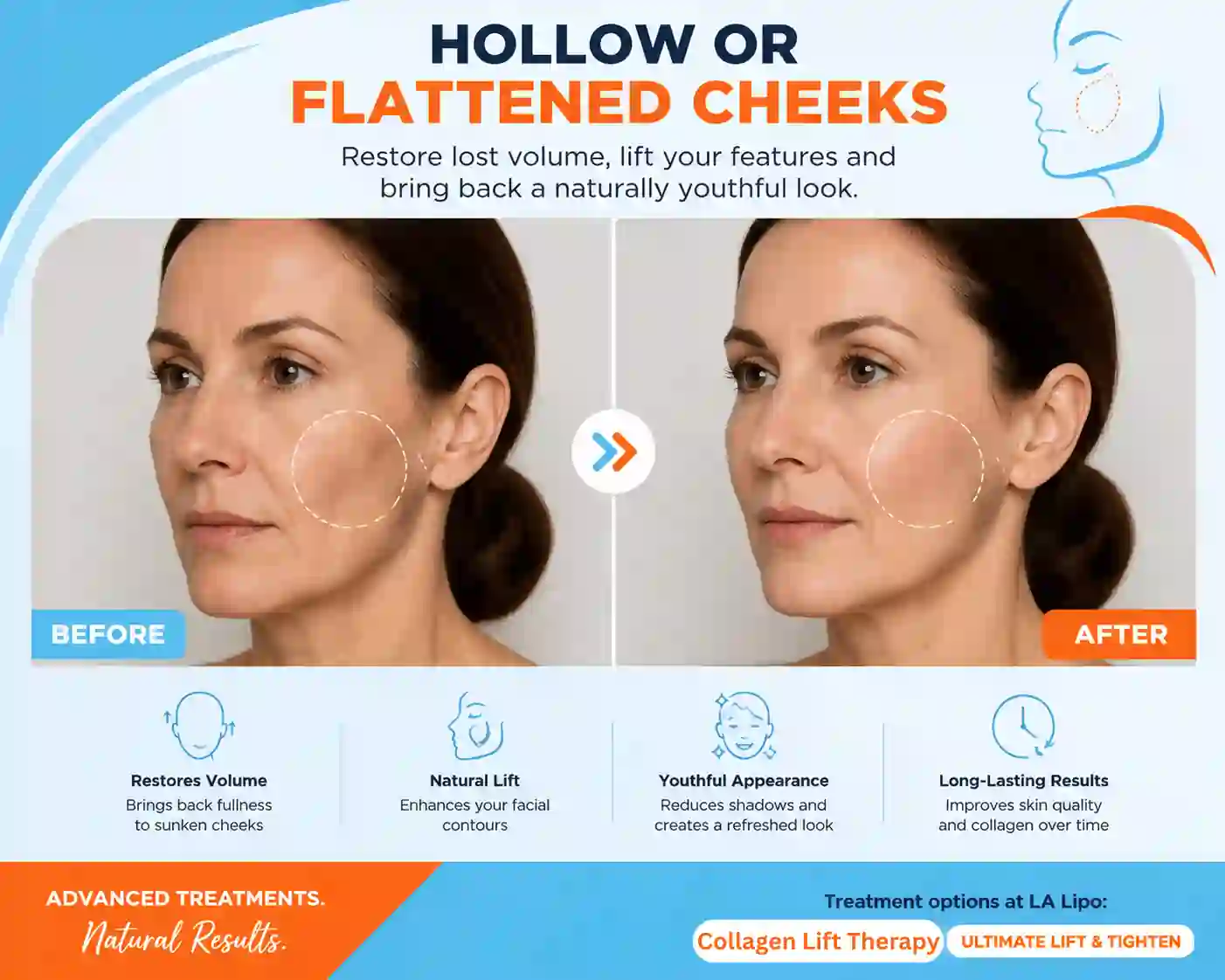 Sign #4: Hollow or Flattened Cheeks Wisbech