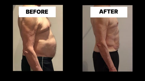 What Symptoms Can Diastasis Recti Cause in Men? Weak Core, Back Pain and Poor Posture Wisbech